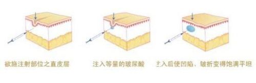 玻尿酸消除法令紋的治療原理圖