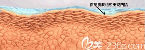 面部出現(xiàn)法令紋后肌膚組織呈現(xiàn)出凹陷