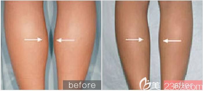注射蘭州瘦腿對(duì)比案例