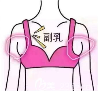 副乳怎么去除