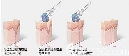 微針去除痘坑痘印的原理