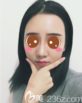 <!--<i data=20240703-sp></i>-->時光何晉龍鼻綜合真人案例術(shù)后47天 <!--<i data=20240703-sp></i>-->時光何晉龍鼻綜合真人案例術(shù)后47天