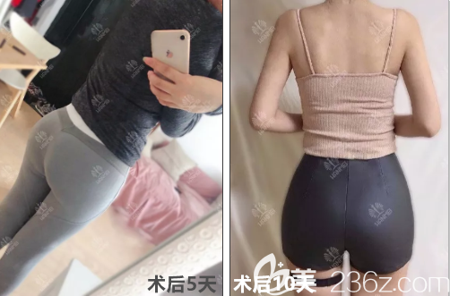 王軍自體脂肪豐臀術(shù)后10天