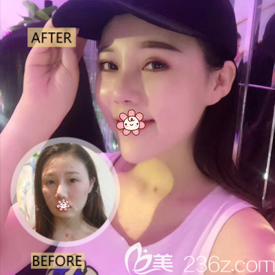 重慶藝星整形朱家旭墊下巴效果 重慶藝星整形朱家旭墊下巴效果