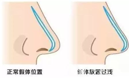 假體置入過淺示意圖