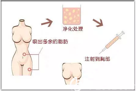 自體脂肪豐胸圖解