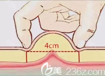 兩個(gè)手指捏起脂肪夠4公分