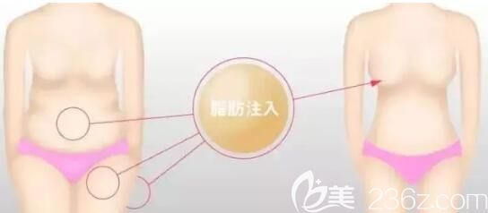 將腹部脂肪轉(zhuǎn)移到胸部