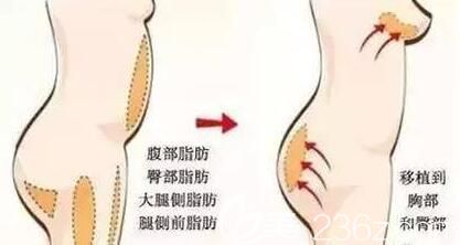 自體脂肪豐臀好不好？