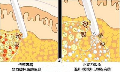 駐馬店締萊美分層腰腹吸脂優(yōu)勢(shì)