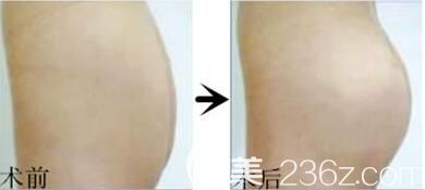 自體脂肪豐臀術(shù)前術(shù)后對比照