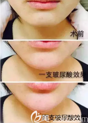 一支玻尿酸和兩支效果對比