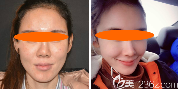 【真實(shí)案例】鼻頭增生圖片