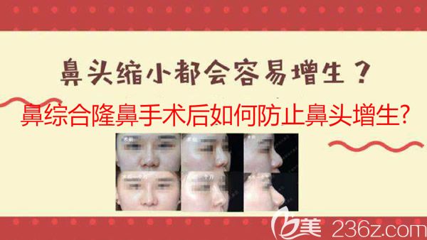 鼻綜合隆鼻后鼻頭增生防止方法介紹
