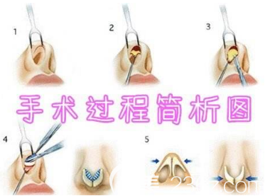 隆鼻手術過程簡析圖