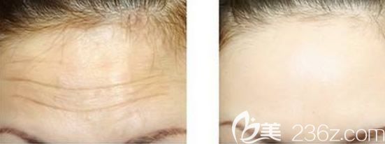 激光去抬頭紋效果