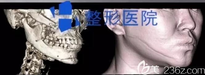 韓國(guó)H整形醫(yī)院下頜角修復(fù)術(shù)前CT圖片