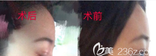 韓國(guó)boneps骨水泥填充額頭真人案例 韓國(guó)boneps骨水泥填充額頭真人案例