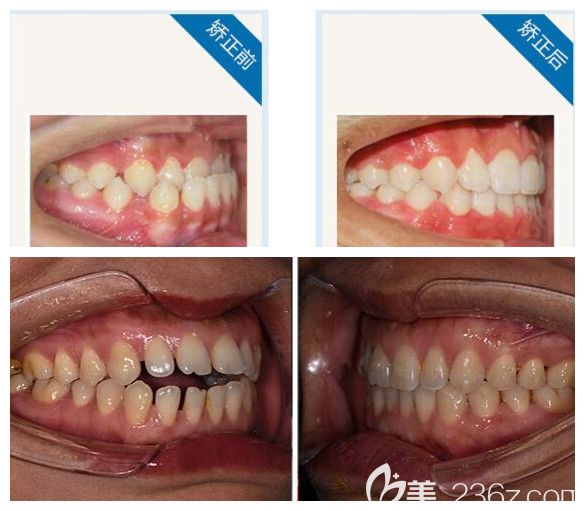 瑞鯊口腔矯正的效果分享