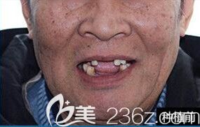 65歲的朱老伯在北京瑞鯊口腔讓于洪海院長種植牙之前 65歲的朱老伯在北京瑞鯊口腔讓于洪海院長種植牙之前