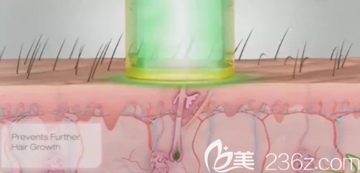 激光脫毛過程圖示