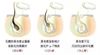 毛發(fā)越粗脫毛越順利