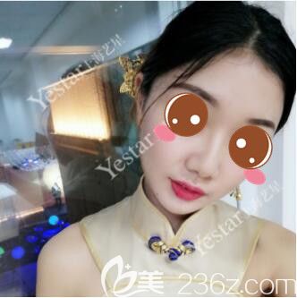 <!--<i data=20240703-sp></i>-->藝星傅金萍鼻綜合真人案例術(shù)后60天