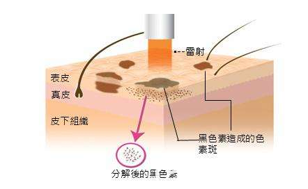 激光祛斑原理示意圖 激光祛斑原理示意圖