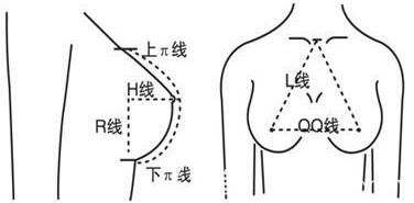 什么是假體隆胸？