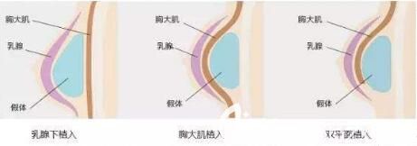  假體隆胸多久能變軟？