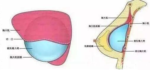 假體隆胸術(shù)后如何快速變軟