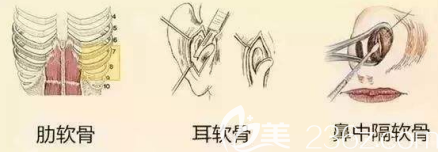 自體軟骨隆鼻的材料