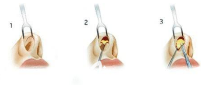 假體隆鼻手術(shù)流程