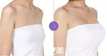 做假體隆胸術(shù)前術(shù)后效果對比照