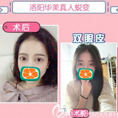 洛陽華美宋俊嶺眼綜合手術(shù)案例