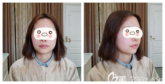 面診南京韓辰術(shù)前唇部較厚 面診南京韓辰術(shù)前唇部較厚