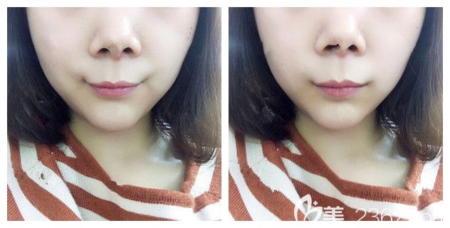 唇部整形術(shù)后半月消腫恢復(fù) 唇部整形術(shù)后半月消腫恢復(fù)