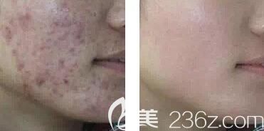 激光治療痤瘡疤痕前后效果對(duì)比照 激光治療痤瘡疤痕前后效果對(duì)比照