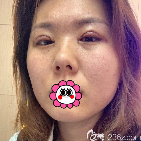 雙眼皮術(shù)后2天