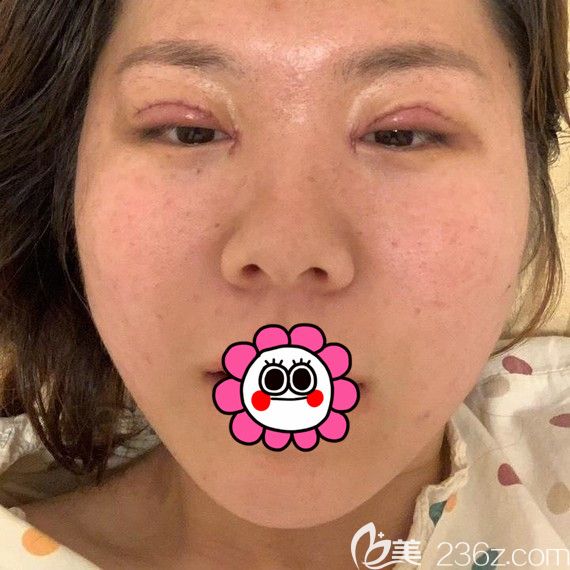 雙眼皮術(shù)后5天