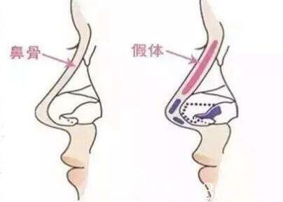 假體隆鼻后遺癥有那些？