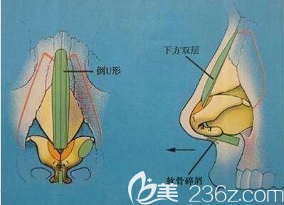 假體隆鼻一定會出現(xiàn)后遺癥嗎？