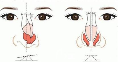 假體隆鼻出現(xiàn)后遺癥應該怎么辦呢？