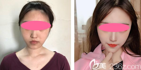 案例二：臉部線雕提升真人案例效果圖