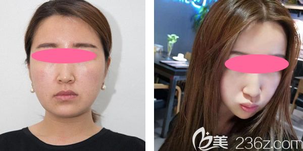 案例三：線雕提升真人案例效果圖