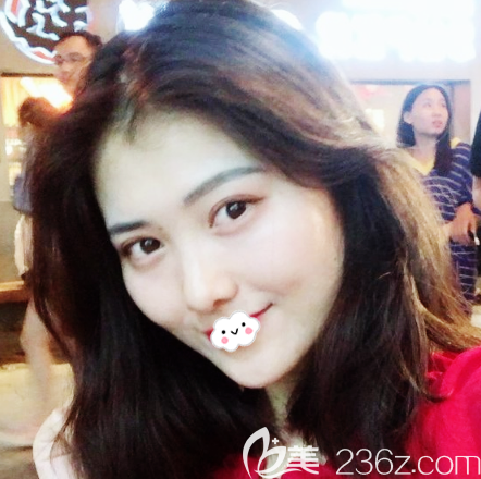 廣州廣大整形醫(yī)院王政醫(yī)生雙眼皮<span style= 廣州廣大整形醫(yī)院王政醫(yī)生雙眼皮<span style=