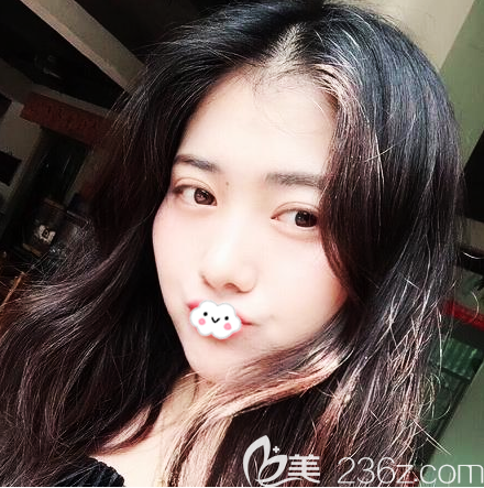 沒想到這次找廣州口碑不錯的廣大醫(yī)院王政做的雙眼皮效果比我想象中的還要好