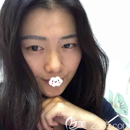 在廣州廣大整形醫(yī)院做雙眼皮術(shù)前照片 在廣州廣大整形醫(yī)院做雙眼皮術(shù)前照片