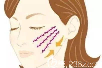 埋線提升能夠改變面部衰老嗎？