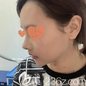 在長沙做完鼻綜合術(shù)后一周效果 在長沙做完鼻綜合術(shù)后一周效果